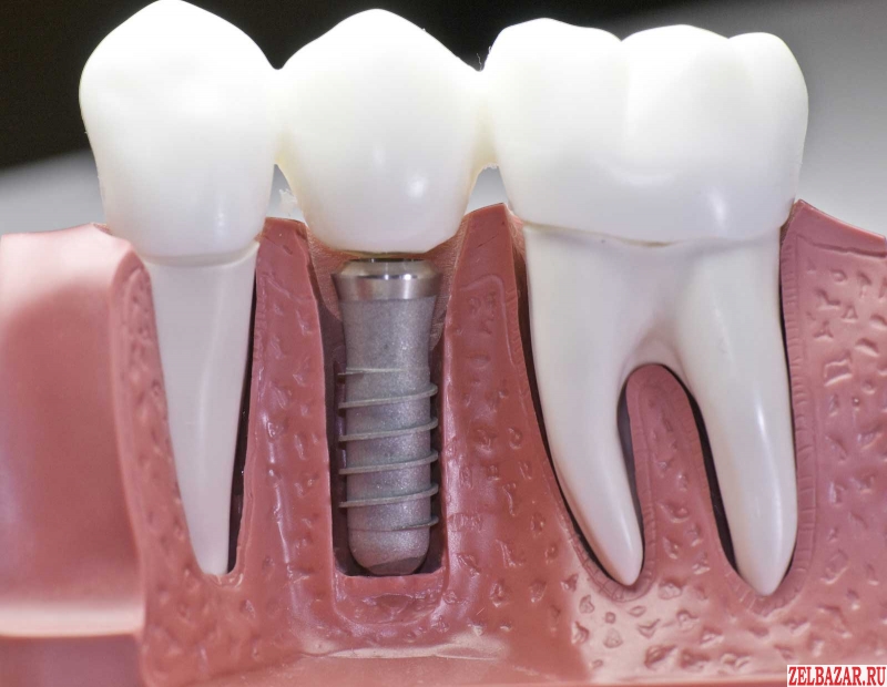 Имплантация и лечение зубов недорого